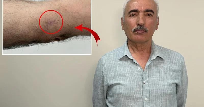 Cilt Kanserine Dikkat: Erken Teşhis Hayat Kurtarır