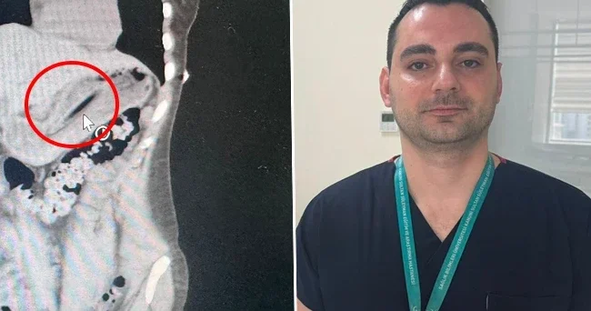 Kilo vermek için yaptı, ameliyata alındı! Doktorlar hayrete düştü: 13 santimetrelik cisim nasıl yutulur?