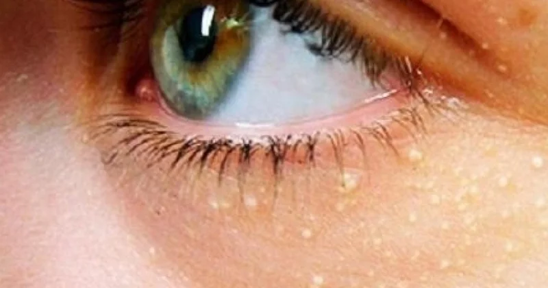 Kalp krizi ve inme riskine işaret eden yüzdeki sarı lekeler: Ksantalazma