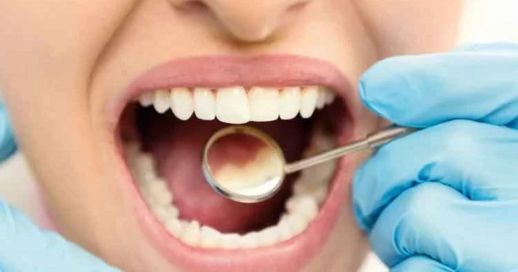 Çürük dişi onaran jel