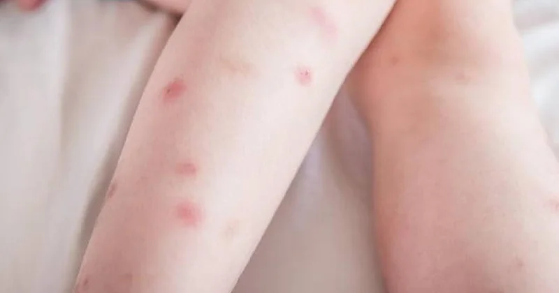 Dünyanın en acı veren ısırığı: Kurşundan daha etkili Sözcü Gazetesi