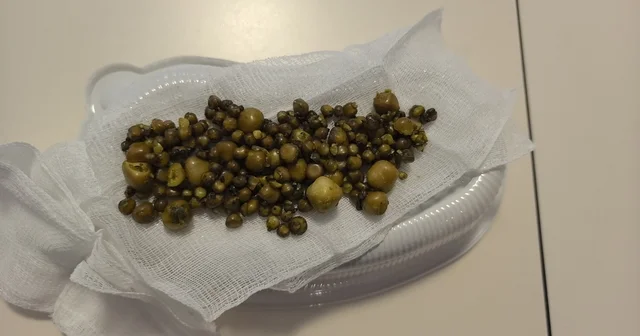 Bursa da 77 yaşındaki kadının safra kesesinden 213 tane taş çıkarıldı Bursa Haberleri