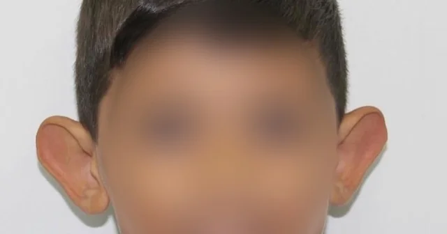 Kepçe kulak sorunu çocuklarda özgüveni zedeliyor Prof. Dr. Hayati Akbaş: Tedavi okul öncesi dönemde mutlaka yapılmalı Samsun Haberleri