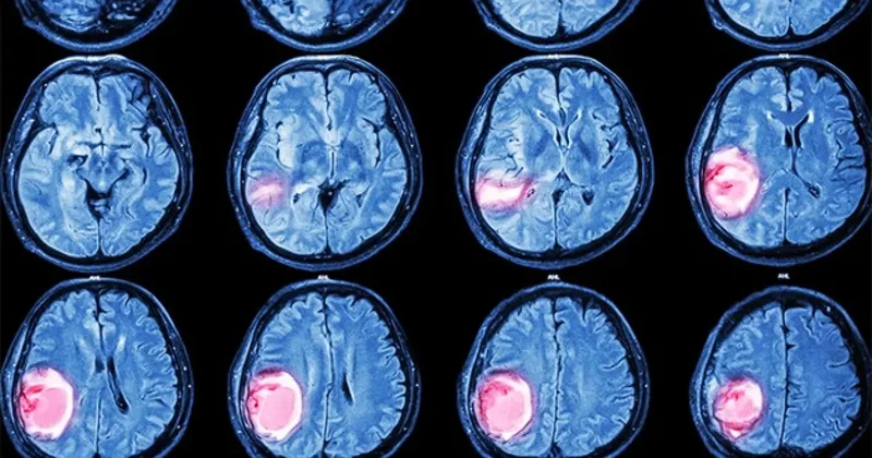 Beyin tümörlerinde 3 kritik sinyal!