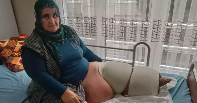 35 yıldır fil hastalığıyla mücadele ediyor