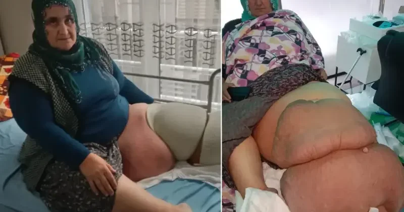 35 yıldır fil hastalığının pençesinde Mersin Haberleri