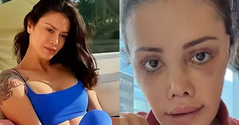 Yüz nakli yaptıran Didem Ceran ın son hali: Harika gözüküyorum