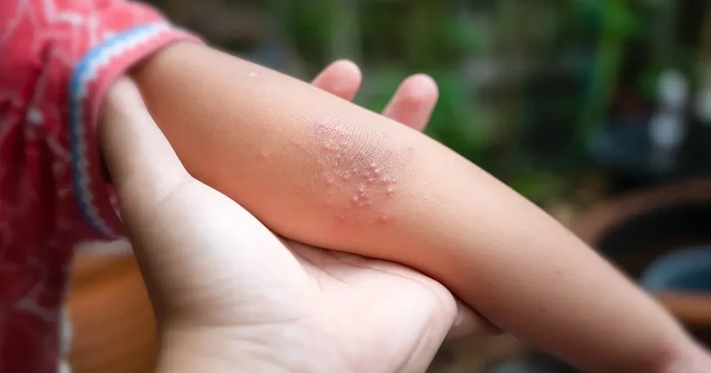 Cam bardak testiyle anlaşılabiliyor! Menenjitte hayati uyarı