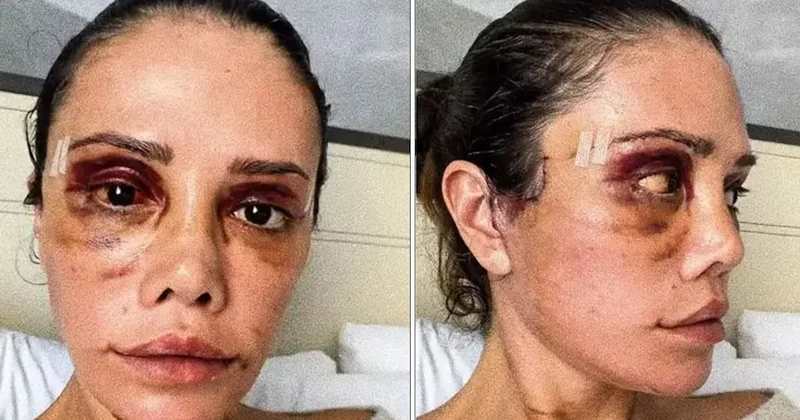 İkinci yüz naklinin ardından felç geçirmişti: Didem Ceran bakın şimdi ne yaptıracak Sözcü Gazetesi