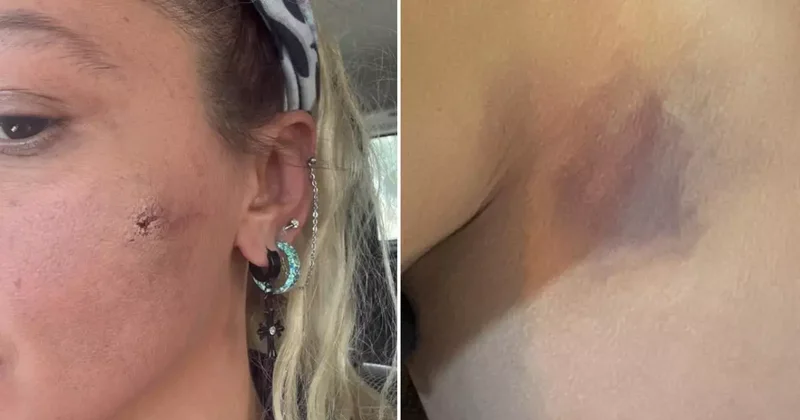 Yıldız Asyalı kocasından şiddet gördüğünü açıkladı