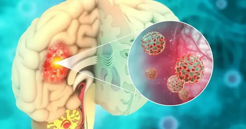 Beyin tümörlerinde baş ağrısı ve kusma kritik uyarı işareti olabilir Sağlık Haberleri