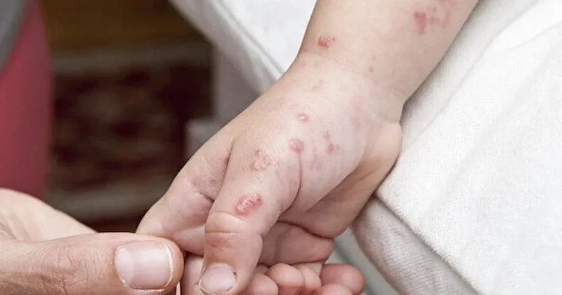 İngiltere alarma geçti: Maymun Çiçeği nin yeni varyantı ortaya çıktı