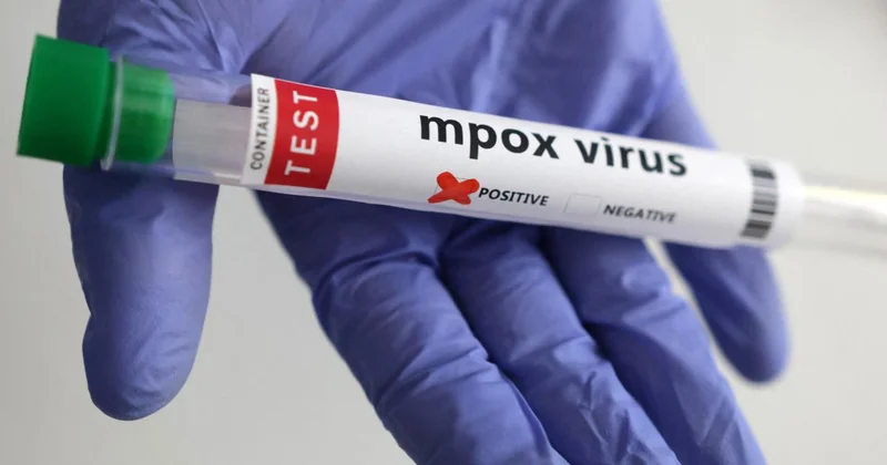 Maymun çiçeği virüsünün yeni bir türü tespit edildi