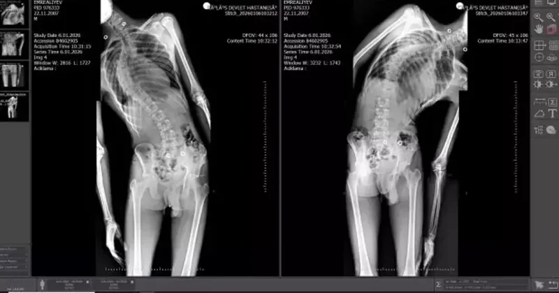 Mersin de önemli başarı: 18 yaşındaki gencin boyu ameliyatla 4 santimetre uzadı