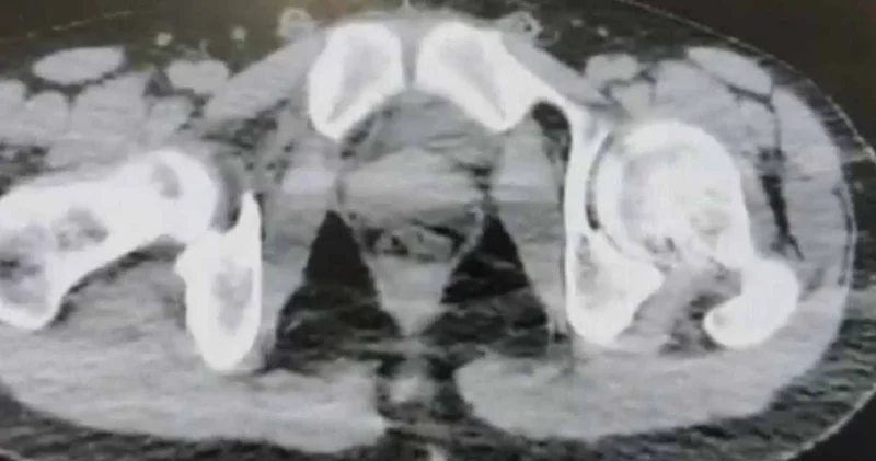 Midelerinde 1 kiloya yakın metamfetaminle yakalandılar