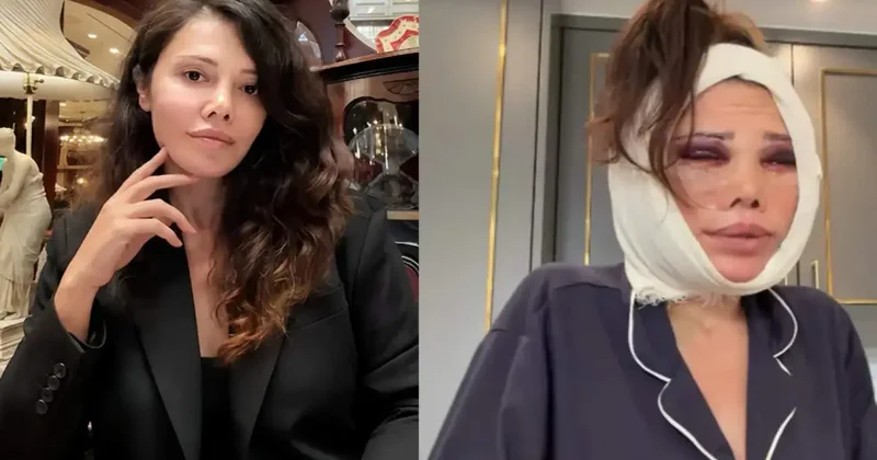 Kore de iki kez yüzünü gerdirdi! Didem Ceran dan yeni ameliyat açıklaması