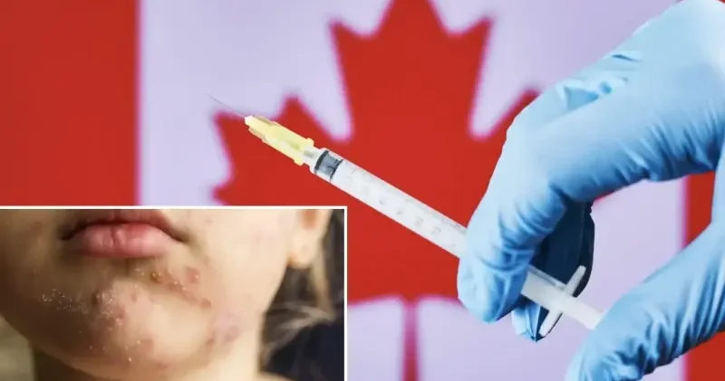 Kanada da kızamık alarmı: Temiz ülke statüsü sona erdi Dünya Haberleri