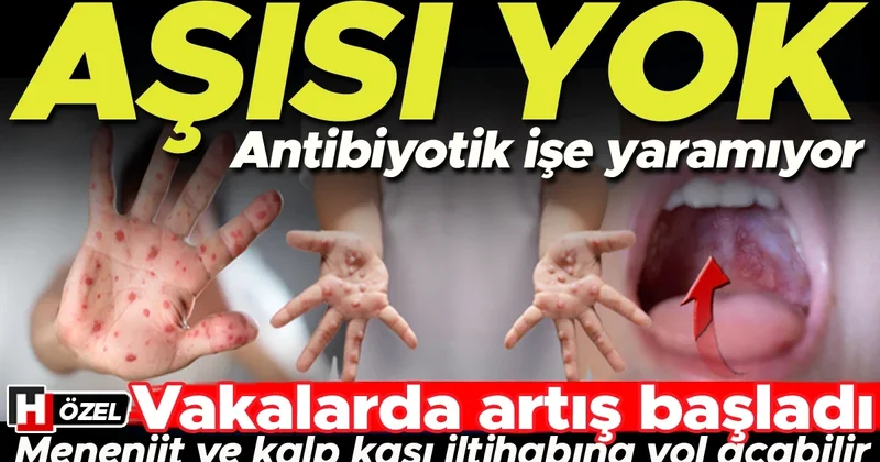 Aşısı yok, antibiyotik işe yaramıyor Vakalardaki artış normal mi? Bazı virüs tipleri menenjit veya kalp kası iltihabına yol açabilir