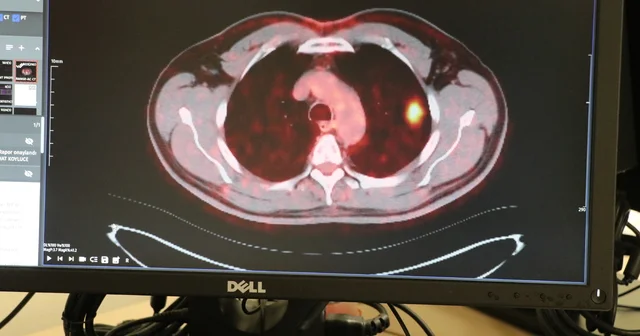 Akciğer kanserini yenen 50 yıllık sigara tiryakisi: 2 aydır adını anmıyorum Kayseri Haberleri