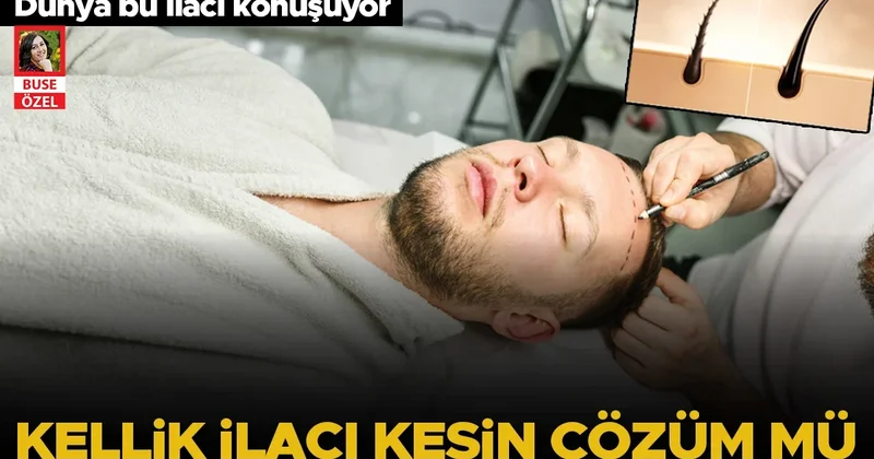 Dünya bu ilacı konuşuyor: Kelliğe merhem umudu