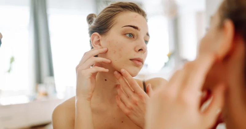 Sivilce sorununa iyi tarafından bakmak isteyenlere: Sivilce ve aknelerin olumlu bir özelliği ortaya çıktı!