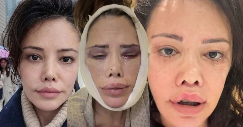 Yüz nakli sonrası bir kez daha bıçak altına yattı: Son haline kimse dayanamadı Sözcü Gazetesi