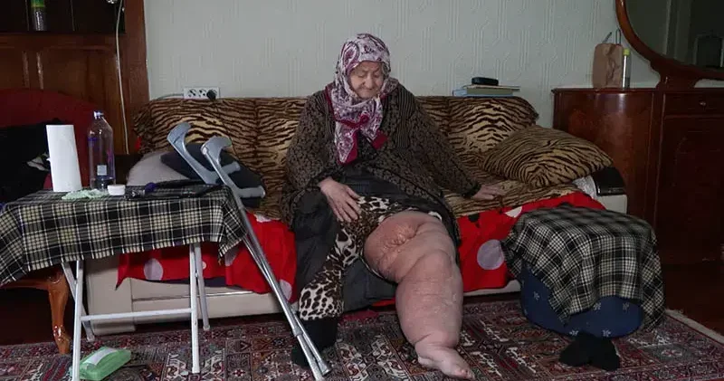 Fil hastalığıyla mücadele ederken oturduğu evin yıkılacağını öğrendi; Bacağım bu haldeyken nereye gideceğim