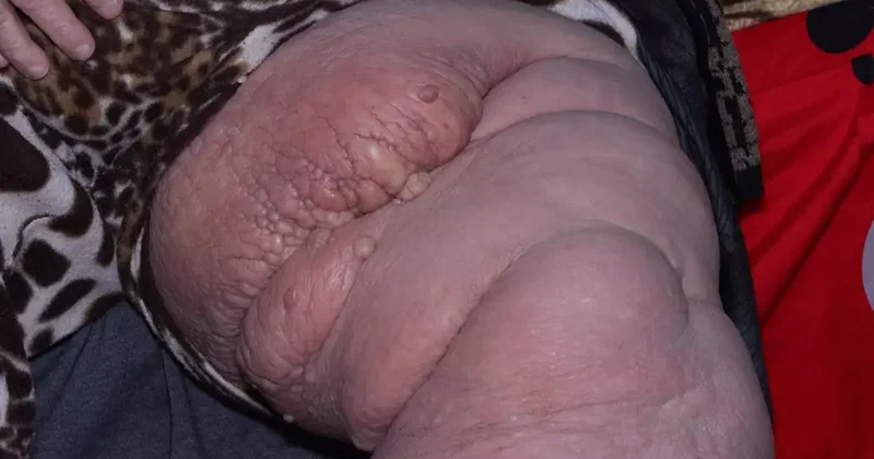 Adı: Fil hastalığı! Bacağı tanınmayacak halde ev aramak zorunda kaldı