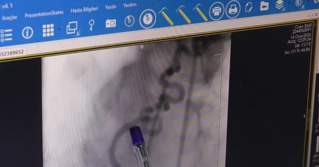Hastanın kalbine giden kanı akciğere yönlendiren anormal damar operasyonla kapatıldı Batman Haberleri