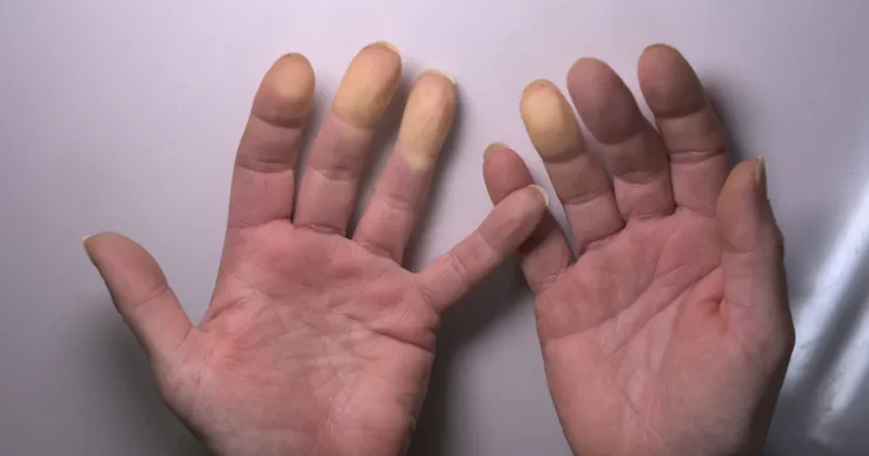 Soğukta parmaklarınız morarıyorsa dikkat! Raynaud hastalığının habercisi olabilir
