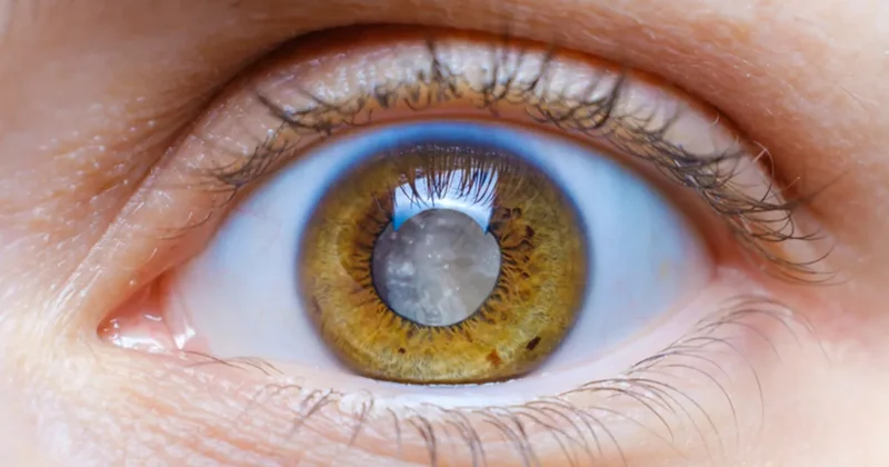 Milyonlarca kişi habersiz: Görme kaybı kapıda bekliyor!