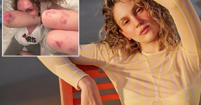 Farah Zeynep Abdullah ın vücudundaki morluklar korkuttu