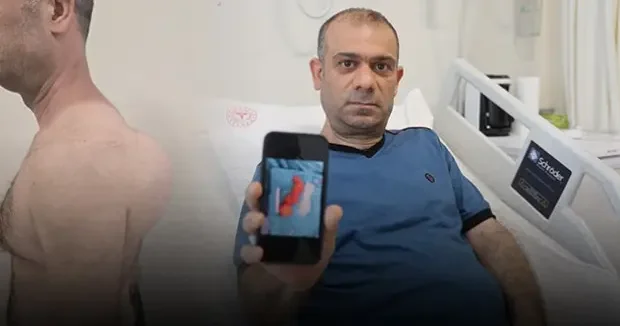 Hatay haberleri Sırtındaki şişliği önemsemedi! Yıllar içinde büyüdü! Doktorları şoke eden vaka 12 Haziran 2026