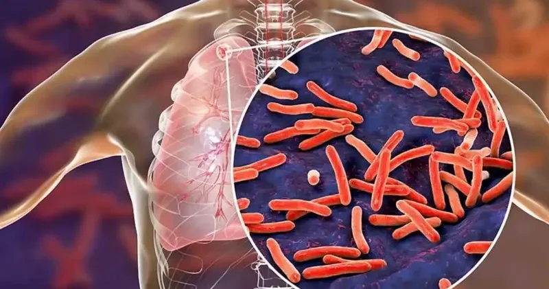 Sessiz salgın: 2024’te 1,2 milyondan fazla kişi tüberkülozdan öldü Sağlık Haberleri