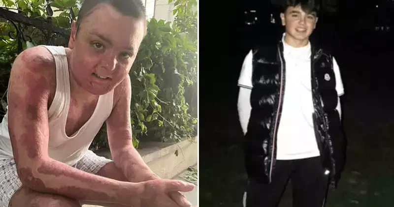 Kağıthane’de kuafördeki yangında tüm vücudu yanan 14 yaşındaki Engin in tedavisi tamamlandı: Kapı sıkışınca çıkamadım yandım