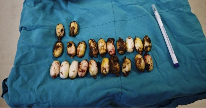 Eskişehir de midesinde 44 kapsül sentetik uyuşturucu tespit edilen şüpheli tutuklandı