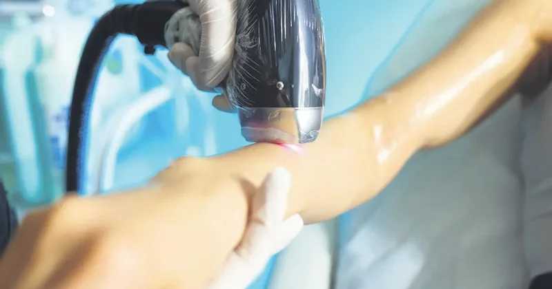 Lazer epilasyon dehşeti