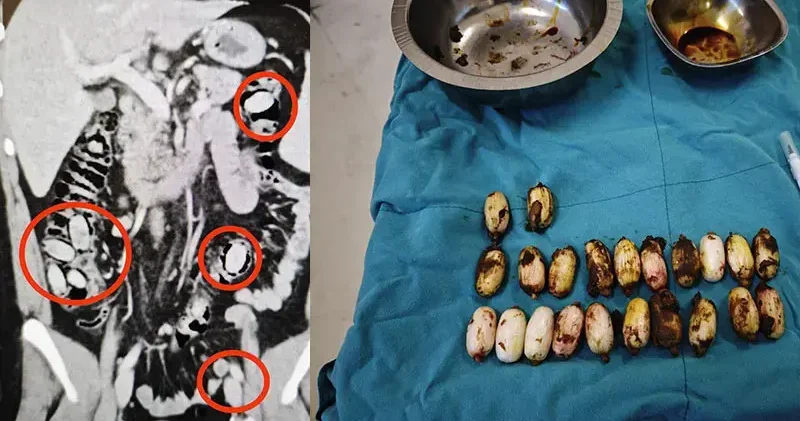 Midesinden 44 kapsül uyuşturucu madde bonzai çıktı