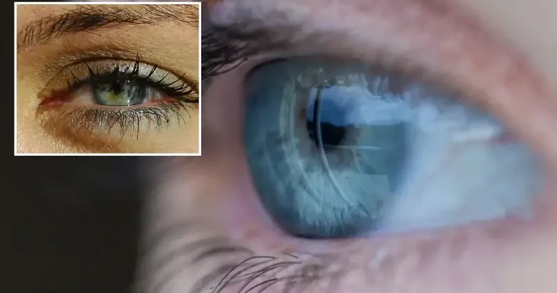 Sağlık Bakanlığı: 2025 te 750 bin kişiye glokom tanısı konuldu Sağlık Haberleri