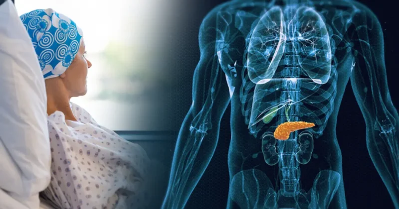 Pankreas kanserinde gözden kaçan 7 belirti!