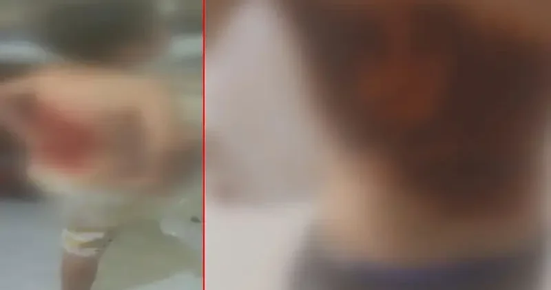 Arnavutköy’de arkadaşları tarafından kolonya dökülüp ateşe verilen 12 yaşındaki çocuk yaralandı