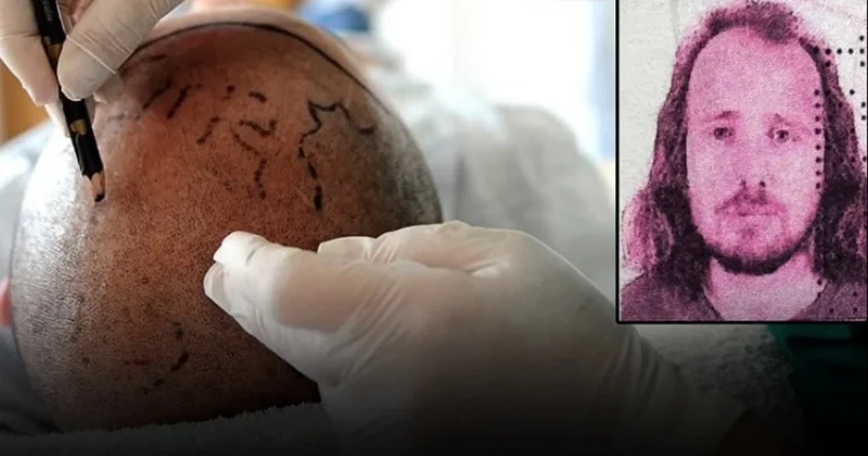 Saç ekimi ve diş tedavisi için Türkiye ye gelen İngiliz turist hayatını kaybetti Sözcü Gazetesi