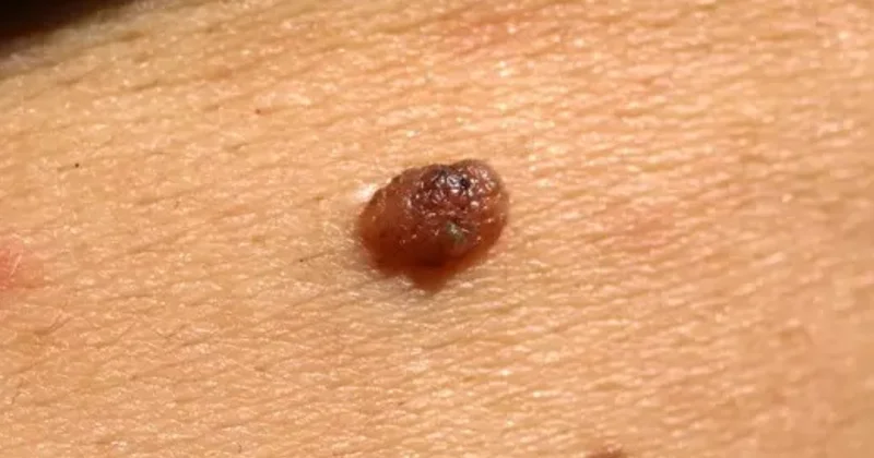 Mutfaktaki basit bir malzeme et benlerinizi küçültüp yok ediyor Sözcü Gazetesi