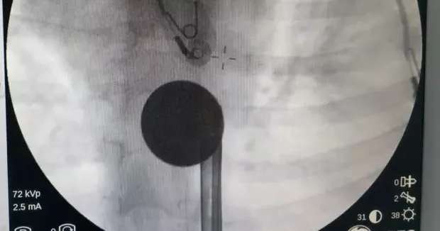 Siirt haberleri Gören inanamadı! 8 yaşındaki çocuğun boğazından çıkartılan şaşırttı 14 Ocak 2026