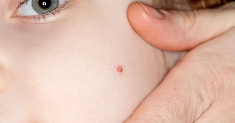 Çocuklarda hangi benler masum hangileri tehlike taşıyor?