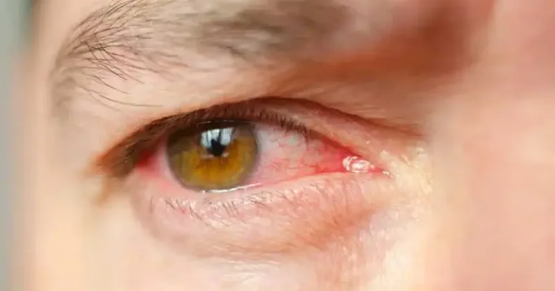 Türkiye’de 2 milyon kişi risk altında! Sessiz ilerliyor, kalıcı körlüğe neden olabiliyor