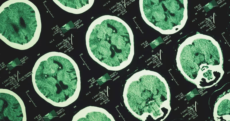 Türk Nöroloji Derneğinden Dünya Uyku Günü mesajı: Beynin sağlığı gece başlar Sağlık Haberleri