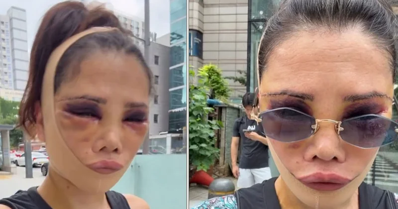 Didem Ceran yeniden ameliyat oldu: Son halini paylaşıp eleştirilere yanıt verdi Sözcü Gazetesi