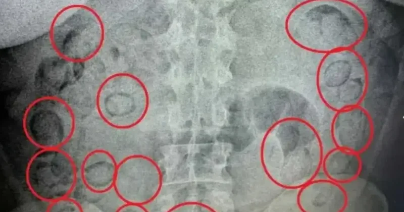 Midesinde yarım kilo uyuşturucu tespit edilen şüpheli tutuklandı