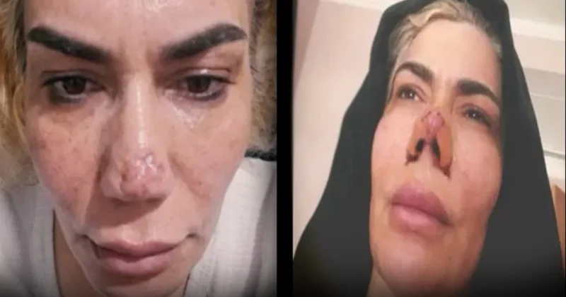 Estetik yaptırmak istedi: Burnu yırtıldı! Sözcü Gazetesi